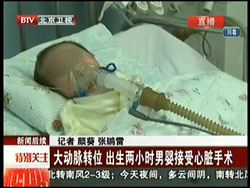 北京电视台：大动脉转位，出生2小时男婴接受心脏手术