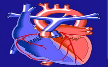 心脏中心为出生四天患儿成功进行大动脉调转手术