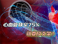 心血管狭窄75%就要放支架，是真的吗？清华大学第一附属医院专家为您解答疑惑（来自CCTV财经频道《是真的吗》节目）