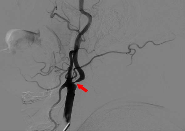 脖子里的 “大脑供血路” 堵了咋办？——从他的手术说起