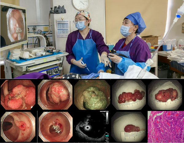 当消化道出血遇到心脏换瓣术后:多学科协作解除患者危机